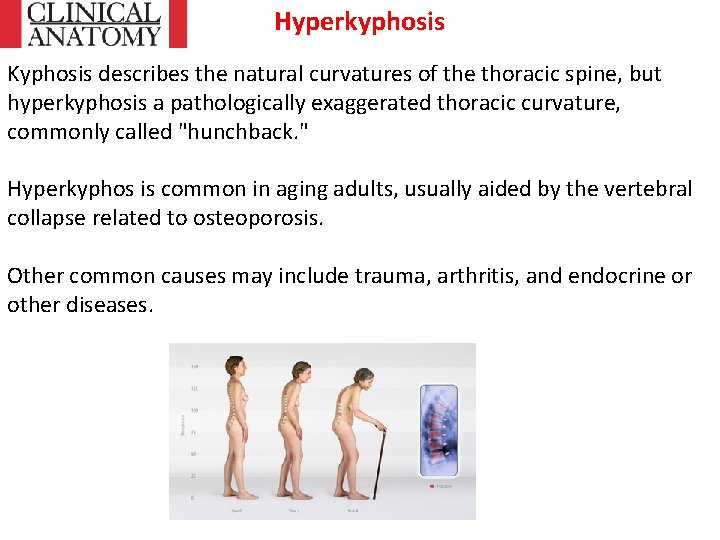 Hyperkyphosis Kyphosis describes the natural curvatures of the thoracic spine, but hyperkyphosis a pathologically