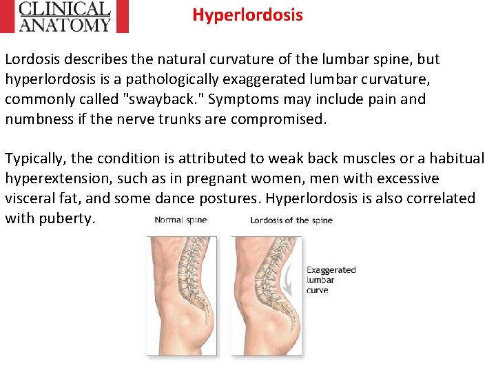 Hyperlordosis Lordosis describes the natural curvature of the lumbar spine, but hyperlordosis is a