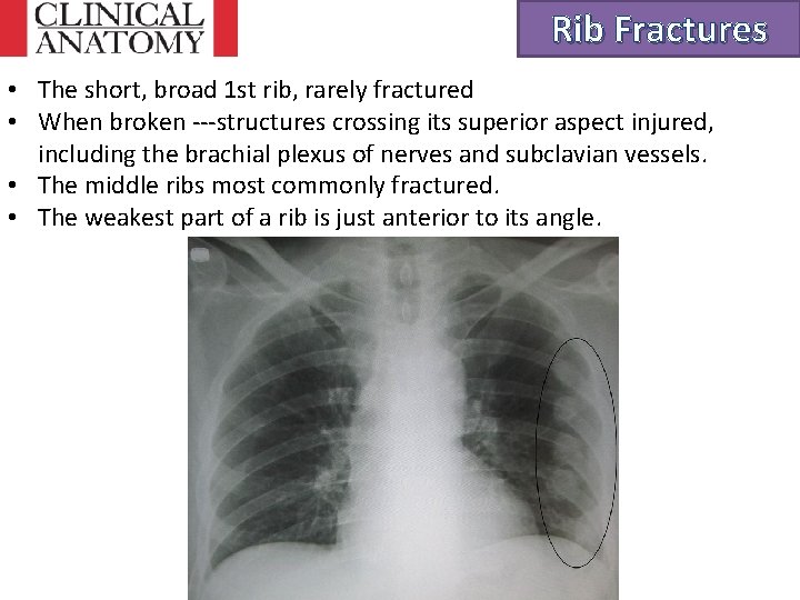 Rib Fractures • The short, broad 1 st rib, rarely fractured • When broken