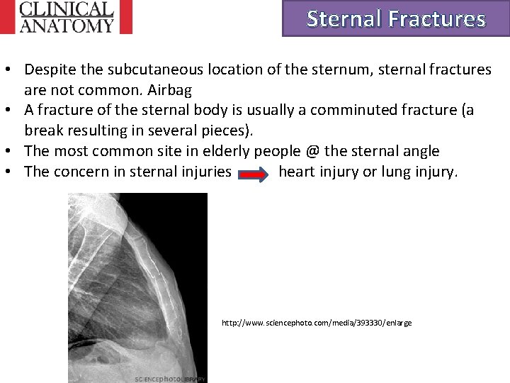 Sternal Fractures • Despite the subcutaneous location of the sternum, sternal fractures are not