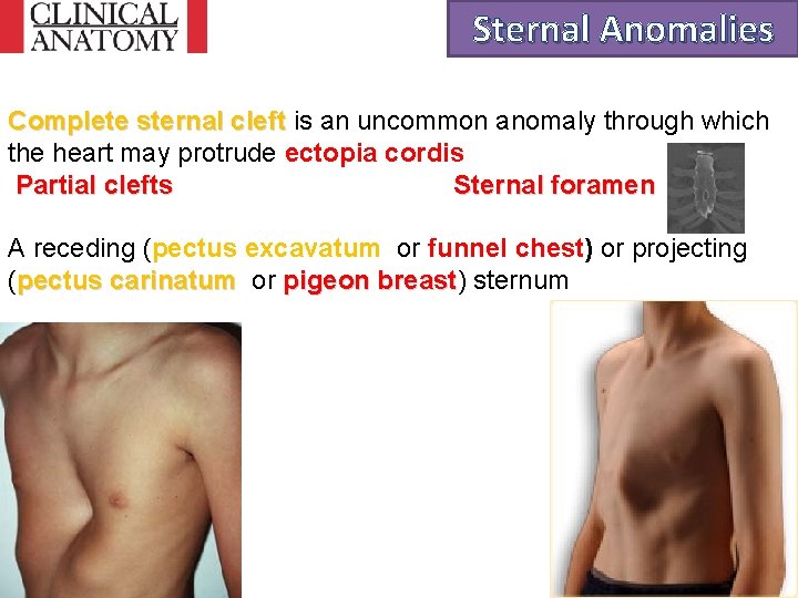 Sternal Anomalies Complete sternal cleft is an uncommon anomaly through which the heart may