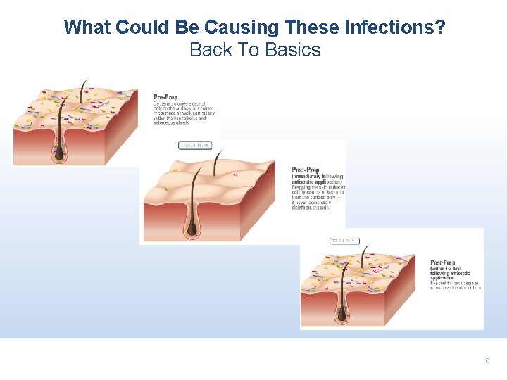 What Could Be Causing These Infections? Back To Basics 6 