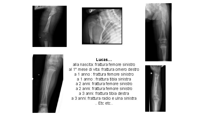 Lucas… alla nascita: frattura femore sinistro al 1° mese di vita: frattura omero destro