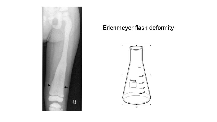 Erlenmeyer flask deformity 