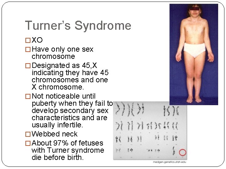Turner’s Syndrome � XO � Have only one sex chromosome � Designated as 45,