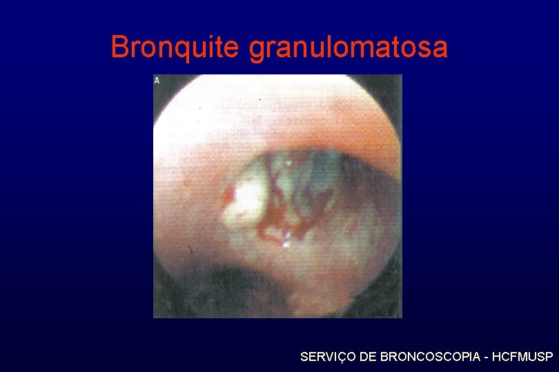 Bronquite granulomatosa SERVIÇO DE BRONCOSCOPIA - HCFMUSP 