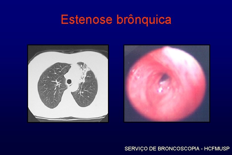 Estenose brônquica SERVIÇO DE BRONCOSCOPIA - HCFMUSP 