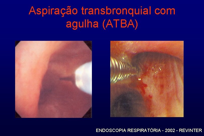 Aspiração transbronquial com agulha (ATBA) ENDOSCOPIA RESPIRATÓRIA - 2002 - REVINTER 