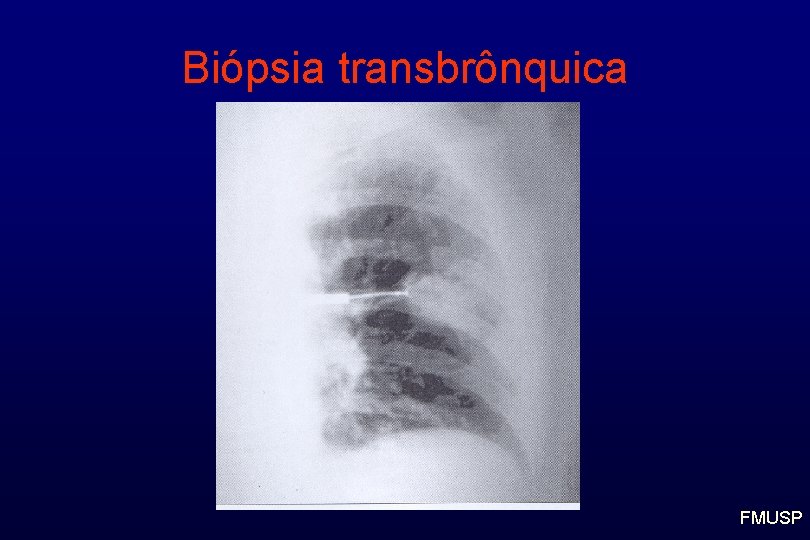 Biópsia transbrônquica FMUSP 