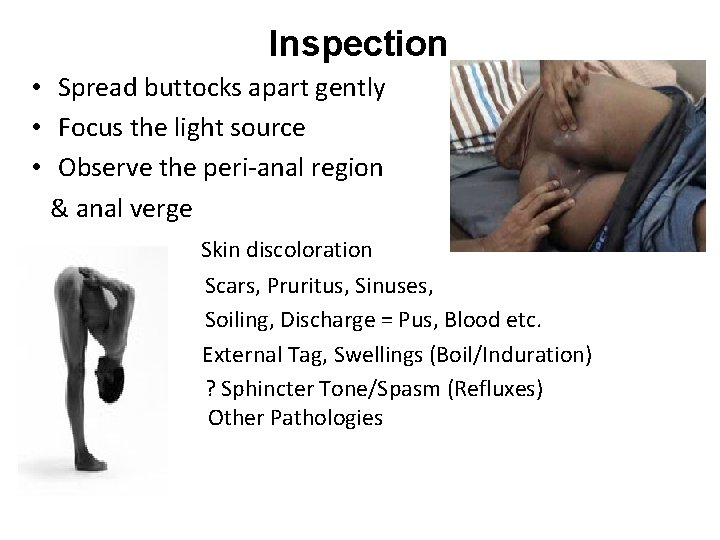 Inspection • Spread buttocks apart gently • Focus the light source • Observe the