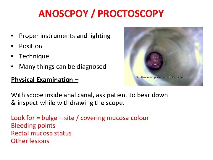 ANOSCPOY / PROCTOSCOPY • • Proper instruments and lighting Position Technique Many things can