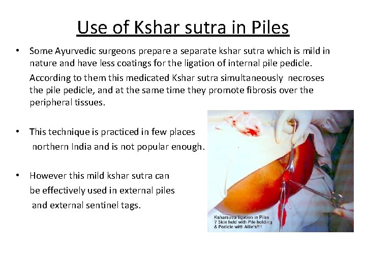 Use of Kshar sutra in Piles • Some Ayurvedic surgeons prepare a separate kshar