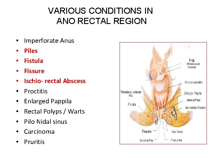 VARIOUS CONDITIONS IN ANO RECTAL REGION • • • Imperforate Anus Piles Fistula Fissure