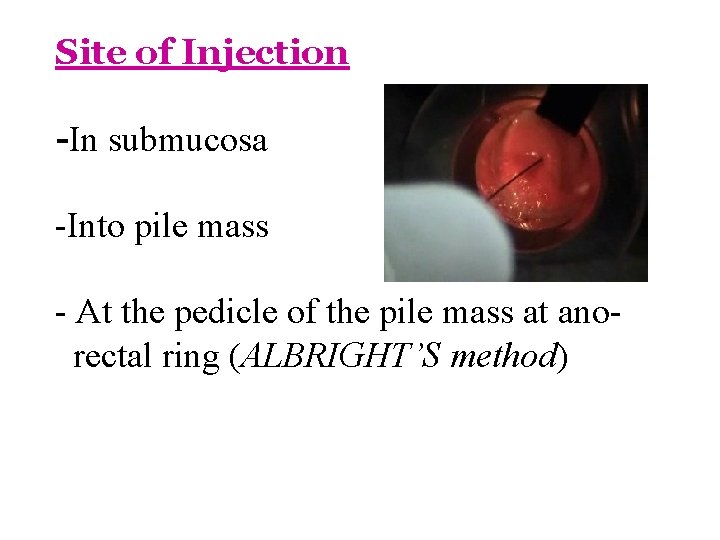 Site of Injection -In submucosa -Into pile mass - At the pedicle of the