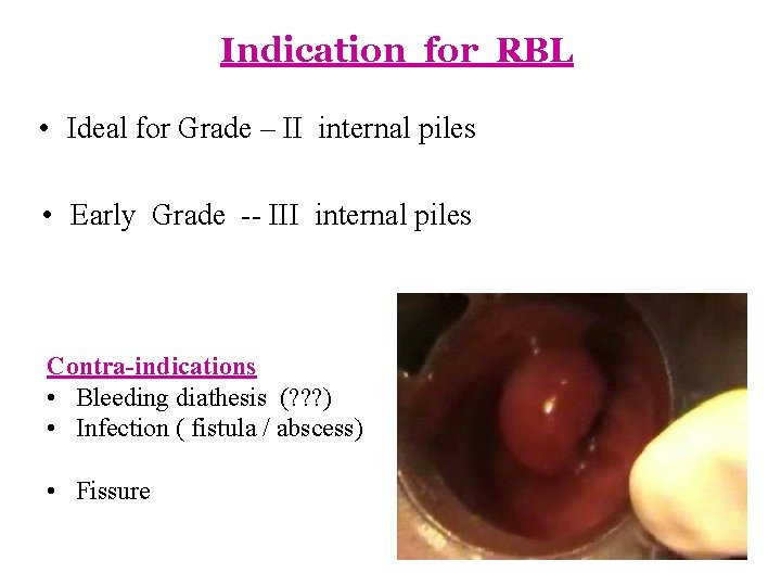 Indication for RBL • Ideal for Grade – II internal piles • Early Grade