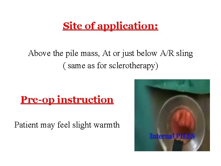 Site of application: Above the pile mass, At or just below A/R sling (