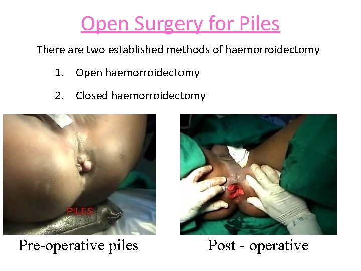 Open Surgery for Piles There are two established methods of haemorroidectomy 1. Open haemorroidectomy