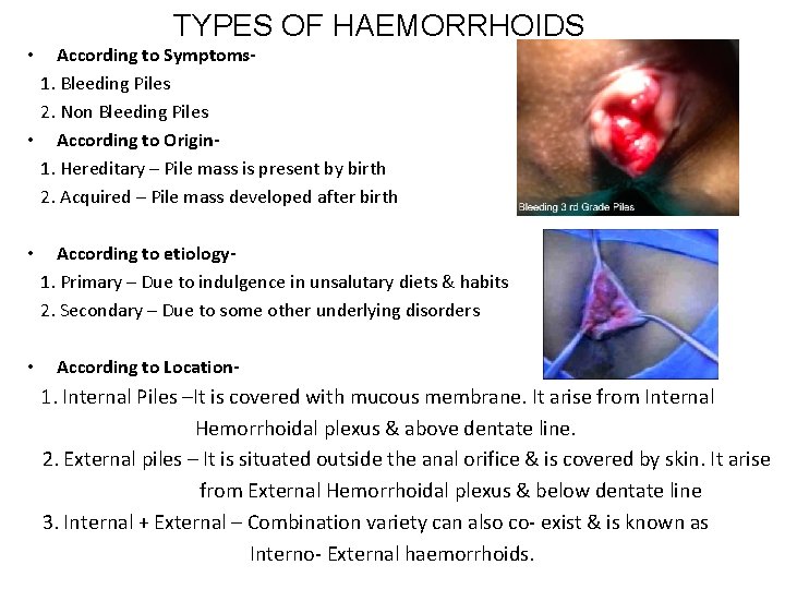 TYPES OF HAEMORRHOIDS According to Symptoms 1. Bleeding Piles 2. Non Bleeding Piles •