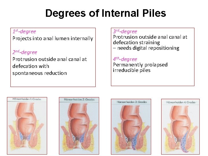 Degrees of Internal Piles 1 st-degree Projects into anal lumen internally 2 nd-degree Protrusion