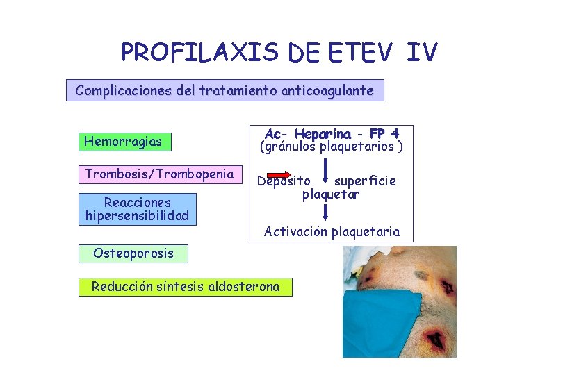 PROFILAXIS DE ETEV IV Complicaciones del tratamiento anticoagulante Hemorragias Trombosis/Trombopenia Reacciones hipersensibilidad Ac- Heparina