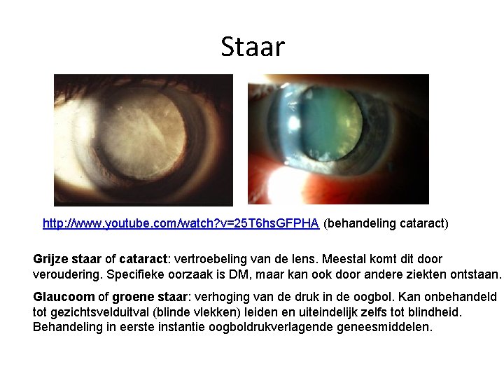 Staar http: //www. youtube. com/watch? v=25 T 6 hs. GFPHA (behandeling cataract) Grijze staar