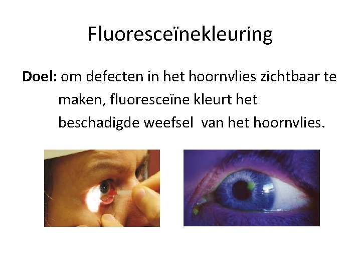 Fluoresceïnekleuring Doel: om defecten in het hoornvlies zichtbaar te maken, fluoresceïne kleurt het beschadigde