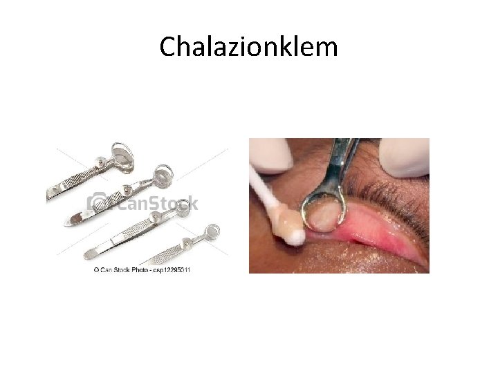 Chalazionklem 