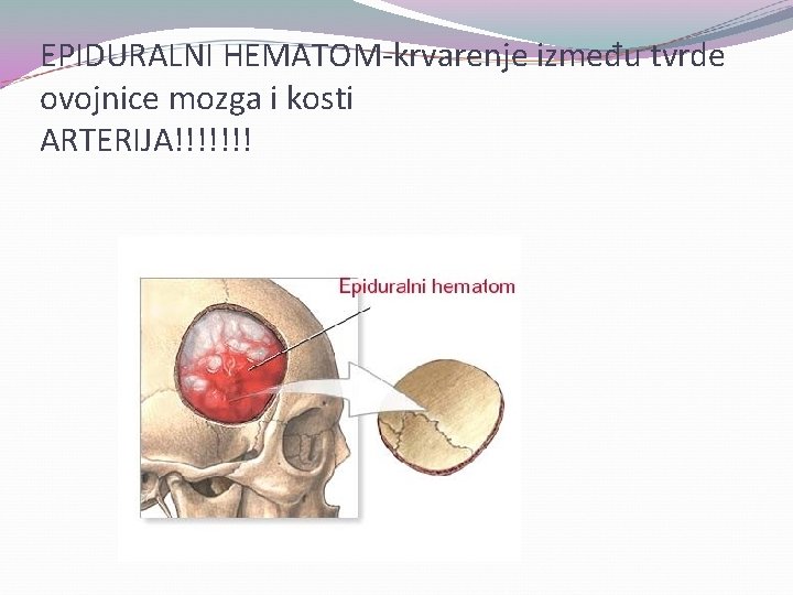 EPIDURALNI HEMATOM-krvarenje između tvrde ovojnice mozga i kosti ARTERIJA!!!!!!! 