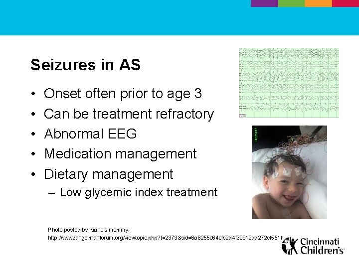 Seizures in AS • • • Onset often prior to age 3 Can be