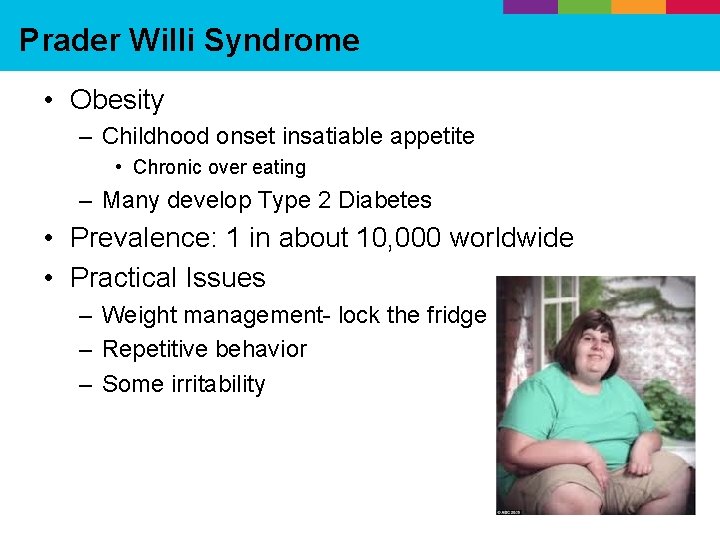 Prader Willi Syndrome • Obesity – Childhood onset insatiable appetite • Chronic over eating