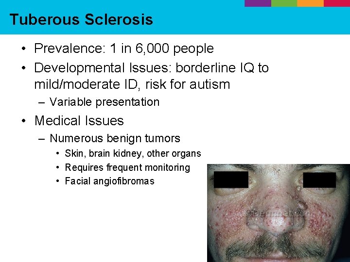 Tuberous Sclerosis • Prevalence: 1 in 6, 000 people • Developmental Issues: borderline IQ