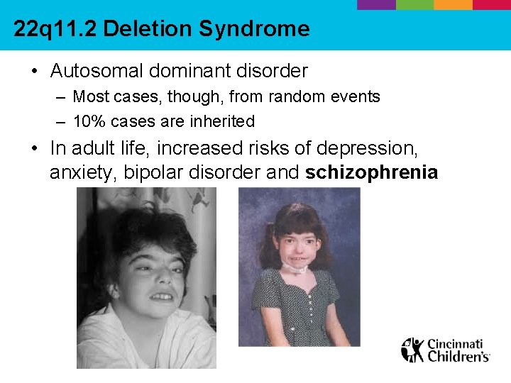 22 q 11. 2 Deletion Syndrome • Autosomal dominant disorder – Most cases, though,