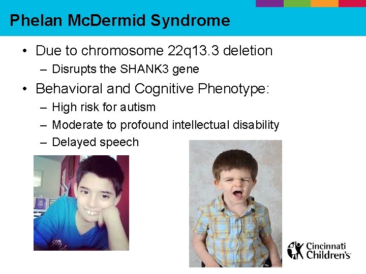 Phelan Mc. Dermid Syndrome • Due to chromosome 22 q 13. 3 deletion –