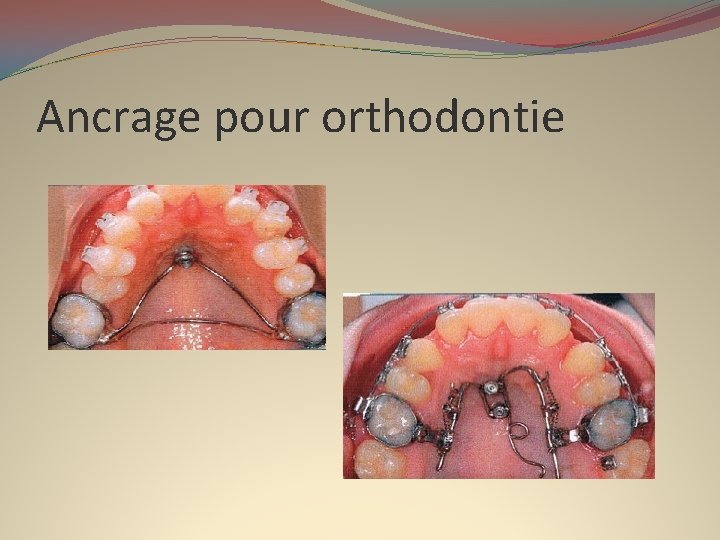 Ancrage pour orthodontie 