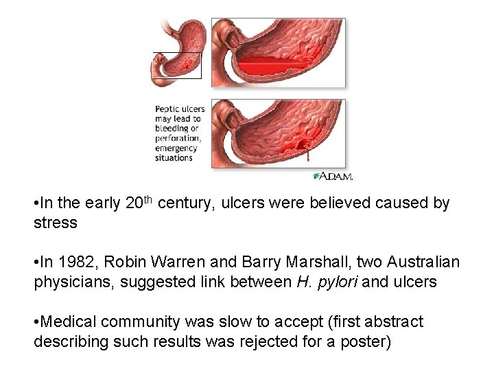  • In the early 20 th century, ulcers were believed caused by stress