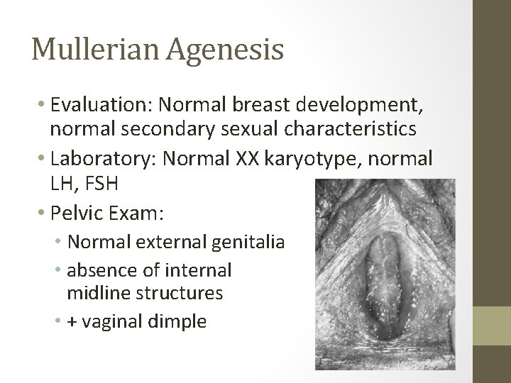 Mullerian Agenesis • Evaluation: Normal breast development, normal secondary sexual characteristics • Laboratory: Normal