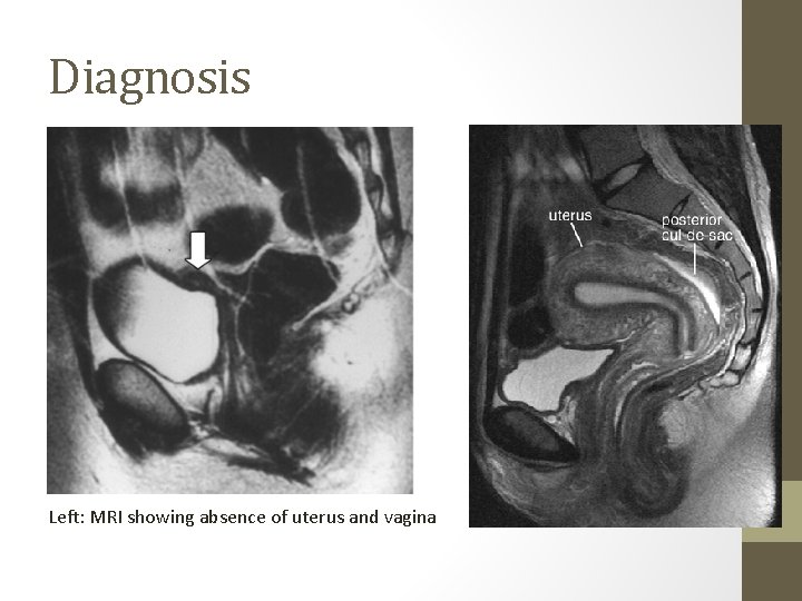 Diagnosis Left: MRI showing absence of uterus and vagina 