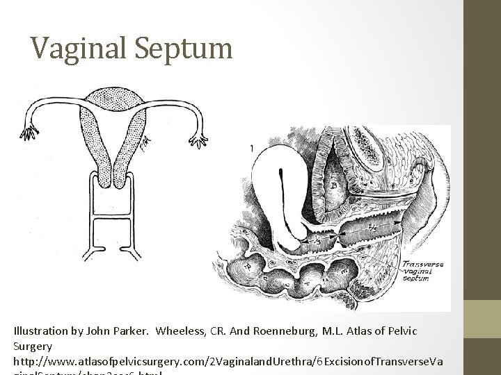 Vaginal Septum Illustration by John Parker. Wheeless, CR. And Roenneburg, M. L. Atlas of