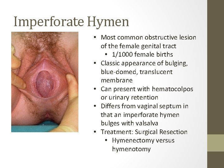 Imperforate Hymen • Most common obstructive lesion of the female genital tract • 1/1000