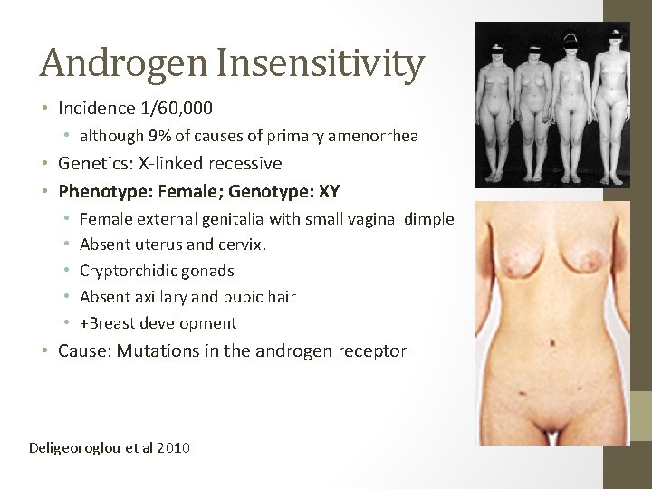 Androgen Insensitivity • Incidence 1/60, 000 • although 9% of causes of primary amenorrhea