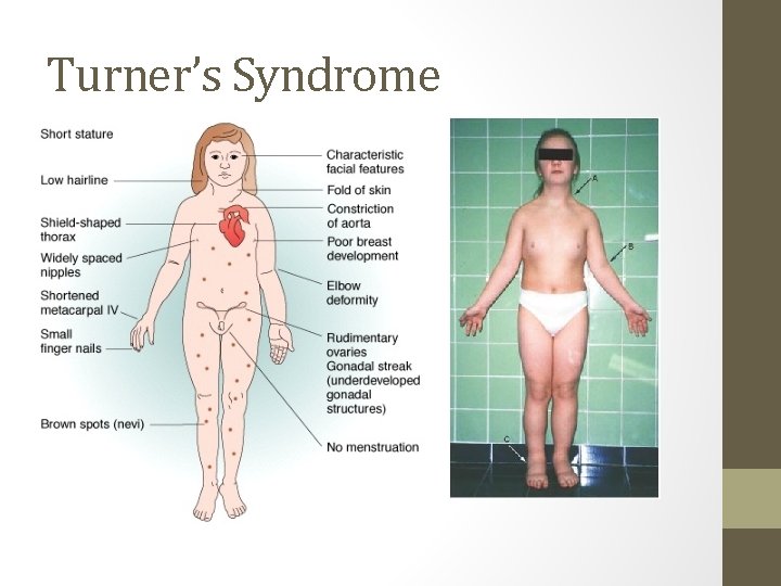 Turner’s Syndrome 