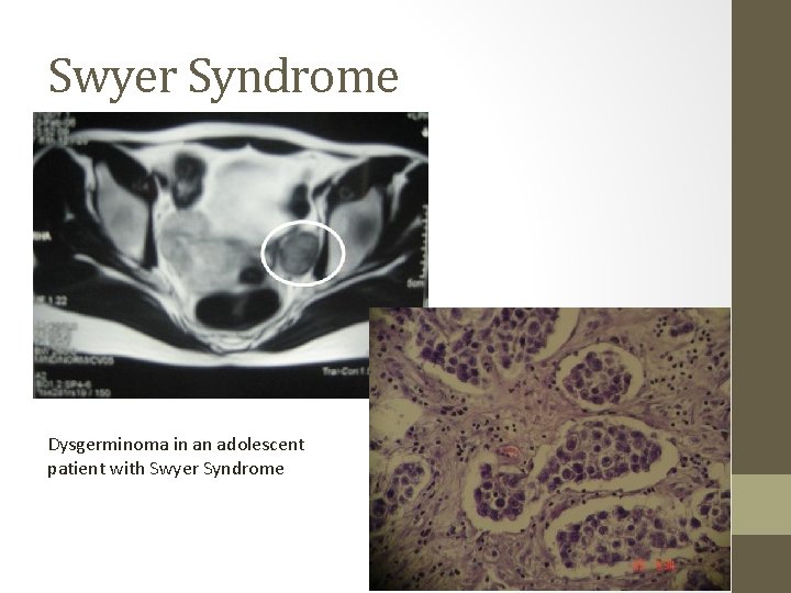 Swyer Syndrome Dysgerminoma in an adolescent patient with Swyer Syndrome 