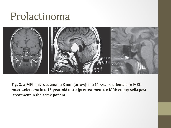 Prolactinoma Fig. 2. a MRI: microadenoma 8 mm (arrow) in a 14 -year-old female.