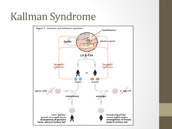 Kallman Syndrome 