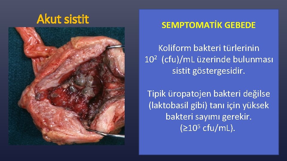 Akut sistit SEMPTOMATİK GEBEDE Koliform bakteri türlerinin 102 (cfu)/m. L üzerinde bulunması sistit göstergesidir.