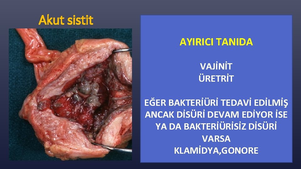 Akut sistit AYIRICI TANIDA VAJİNİT ÜRETRİT EĞER BAKTERİÜRİ TEDAVİ EDİLMİŞ ANCAK DİSÜRİ DEVAM EDİYOR