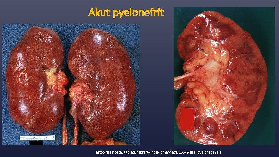 Akut pyelonefrit http: //peir. path. uab. edu/library/index. php? /tags/155 -acute_pyelonephritis 