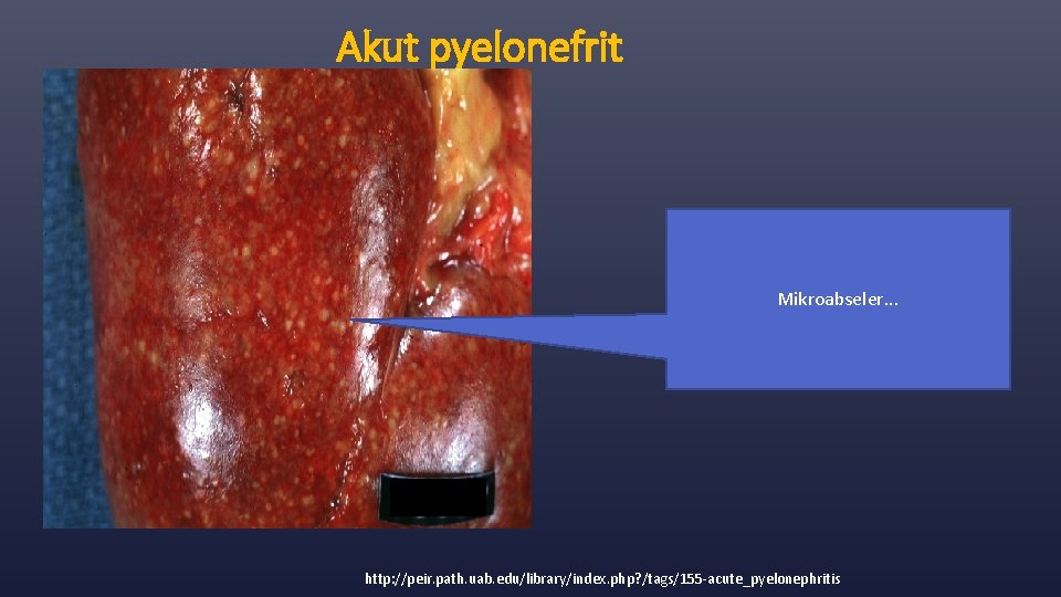 Akut pyelonefrit Mikroabseler. . . http: //peir. path. uab. edu/library/index. php? /tags/155 -acute_pyelonephritis 