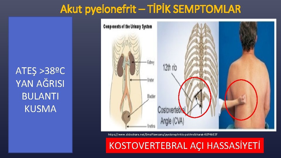 Akut pyelonefrit – TİPİK SEMPTOMLAR ATEŞ >38ºC YAN AĞRISI BULANTI KUSMA https: //www. slideshare.