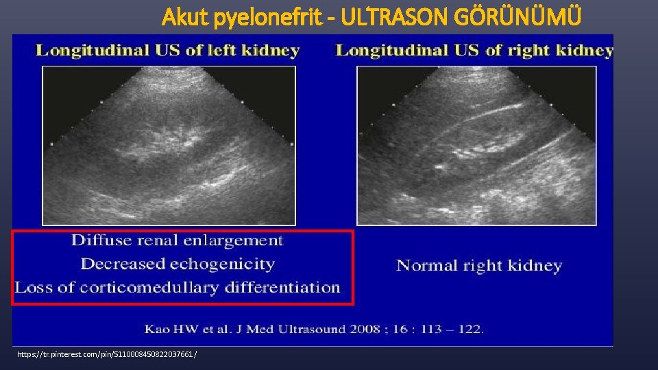 Akut pyelonefrit - ULTRASON GÖRÜNÜMÜ https: //tr. pinterest. com/pin/5110008450822037661/ 